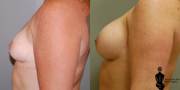 Before & After Breast Augmentation Case 4 View #2 View in Springfield, MA