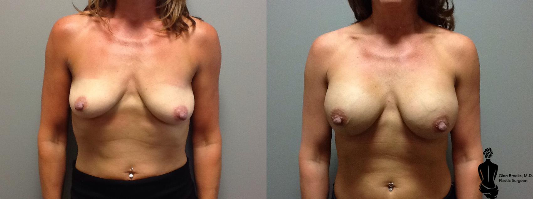 Before & After Breast Augmentation Case 46 View #1 View in Springfield, MA