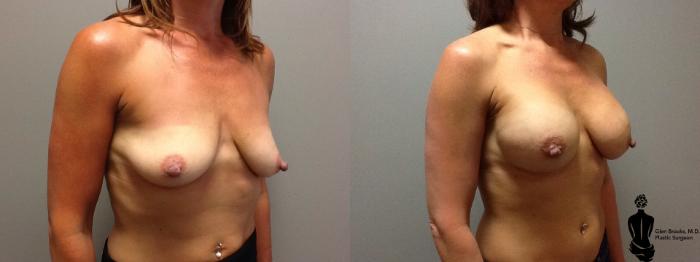 Before & After Breast Augmentation Case 46 View #2 View in Springfield, MA