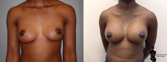 Before & After Breast Augmentation Case 47 View #1 View in Springfield, MA