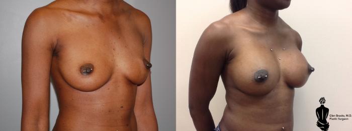Before & After Breast Augmentation Case 47 View #2 View in Springfield, MA