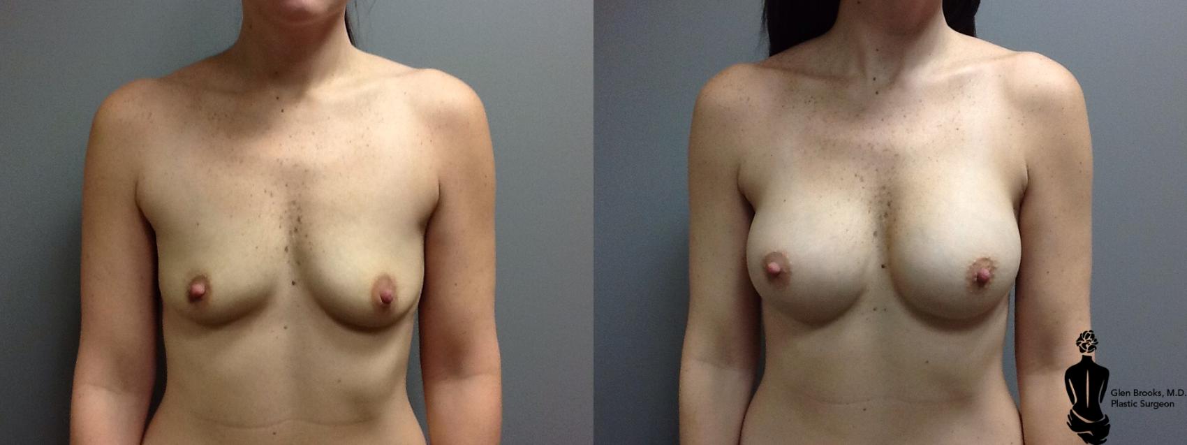 Before & After Breast Augmentation Case 48 View #1 View in Springfield, MA
