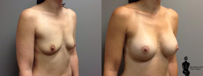 Before & After Breast Augmentation Case 48 View #2 View in Springfield, MA