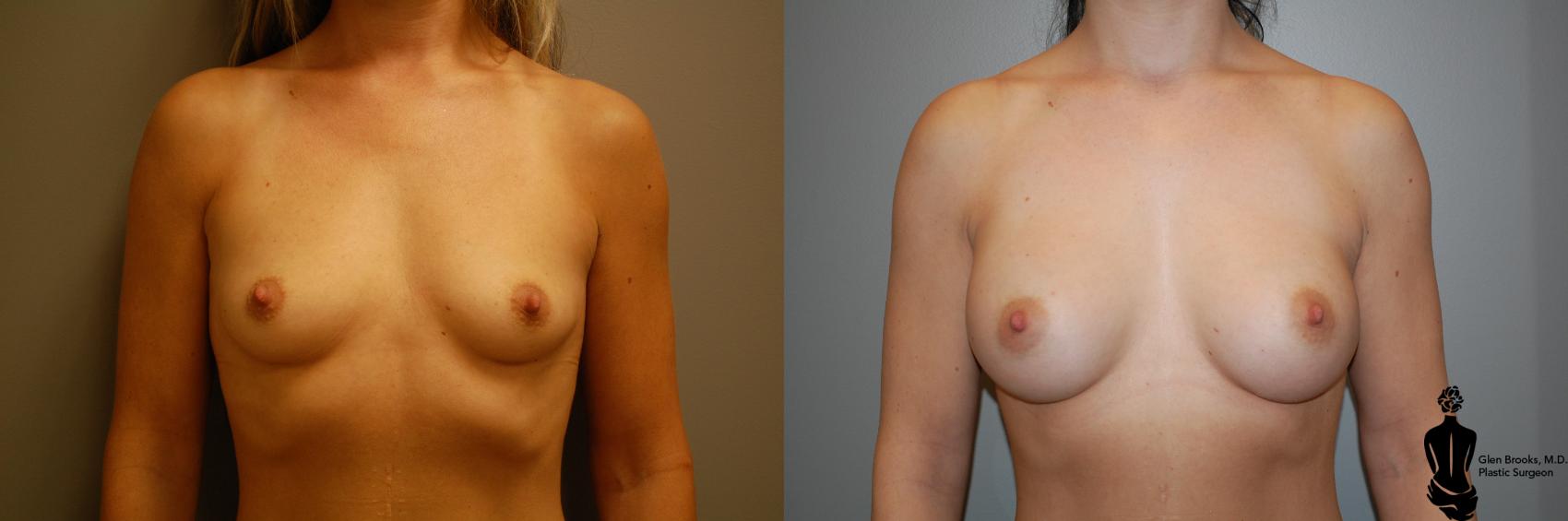 Before & After Breast Augmentation Case 49 View #1 View in Springfield, MA