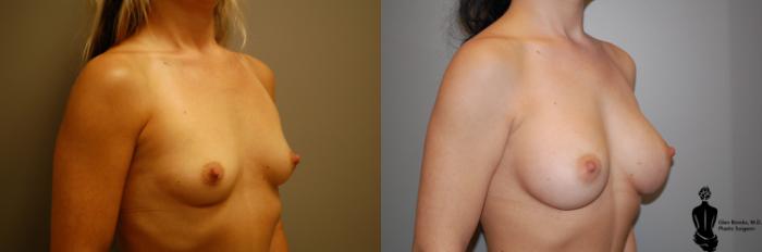 Before & After Breast Augmentation Case 49 View #2 View in Springfield, MA