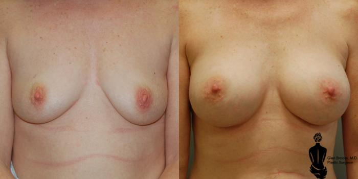 Before & After Breast Augmentation Case 5 View #1 View in Springfield, MA