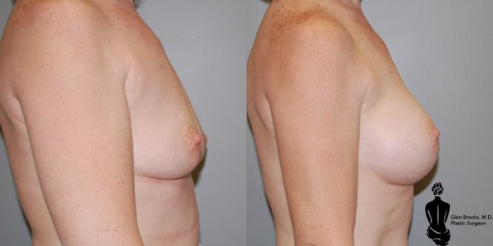 Before & After Breast Augmentation Case 5 View #2 View in Springfield, MA