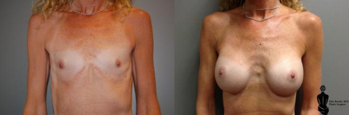 Before & After Breast Augmentation Case 50 View #1 View in Springfield, MA