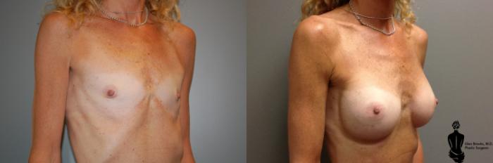 Before & After Breast Augmentation Case 50 View #2 View in Springfield, MA