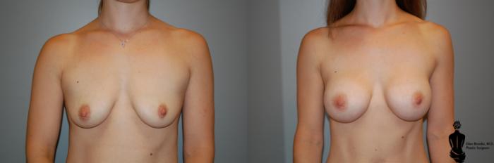 Before & After Breast Augmentation Case 51 View #1 View in Springfield, MA