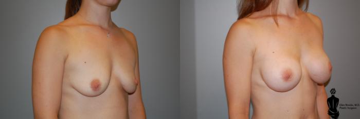 Before & After Breast Augmentation Case 51 View #2 View in Springfield, MA
