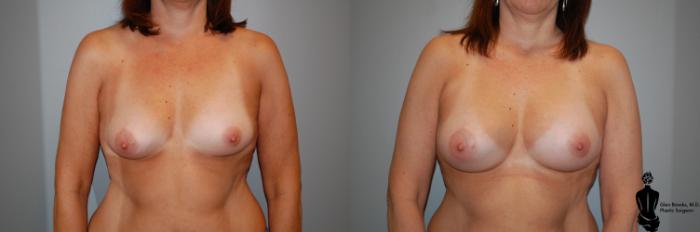 Before & After Breast Augmentation Case 52 View #1 View in Springfield, MA