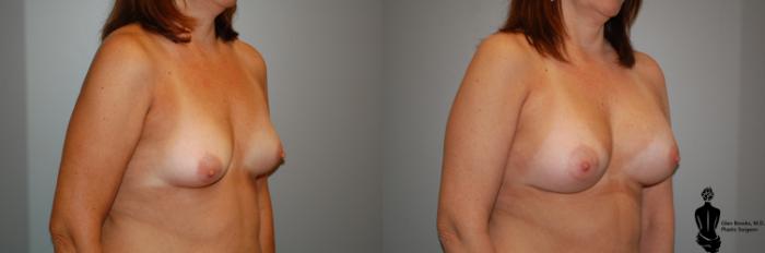 Before & After Breast Augmentation Case 52 View #2 View in Springfield, MA