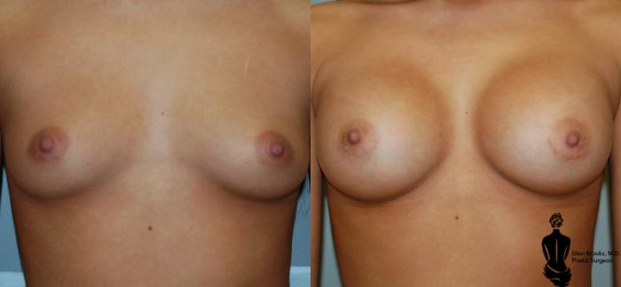 Before & After Breast Augmentation Case 6 View #1 View in Springfield, MA