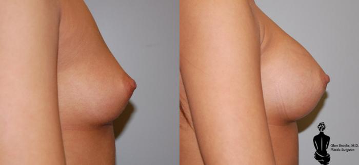 Before & After Breast Augmentation Case 6 View #2 View in Springfield, MA