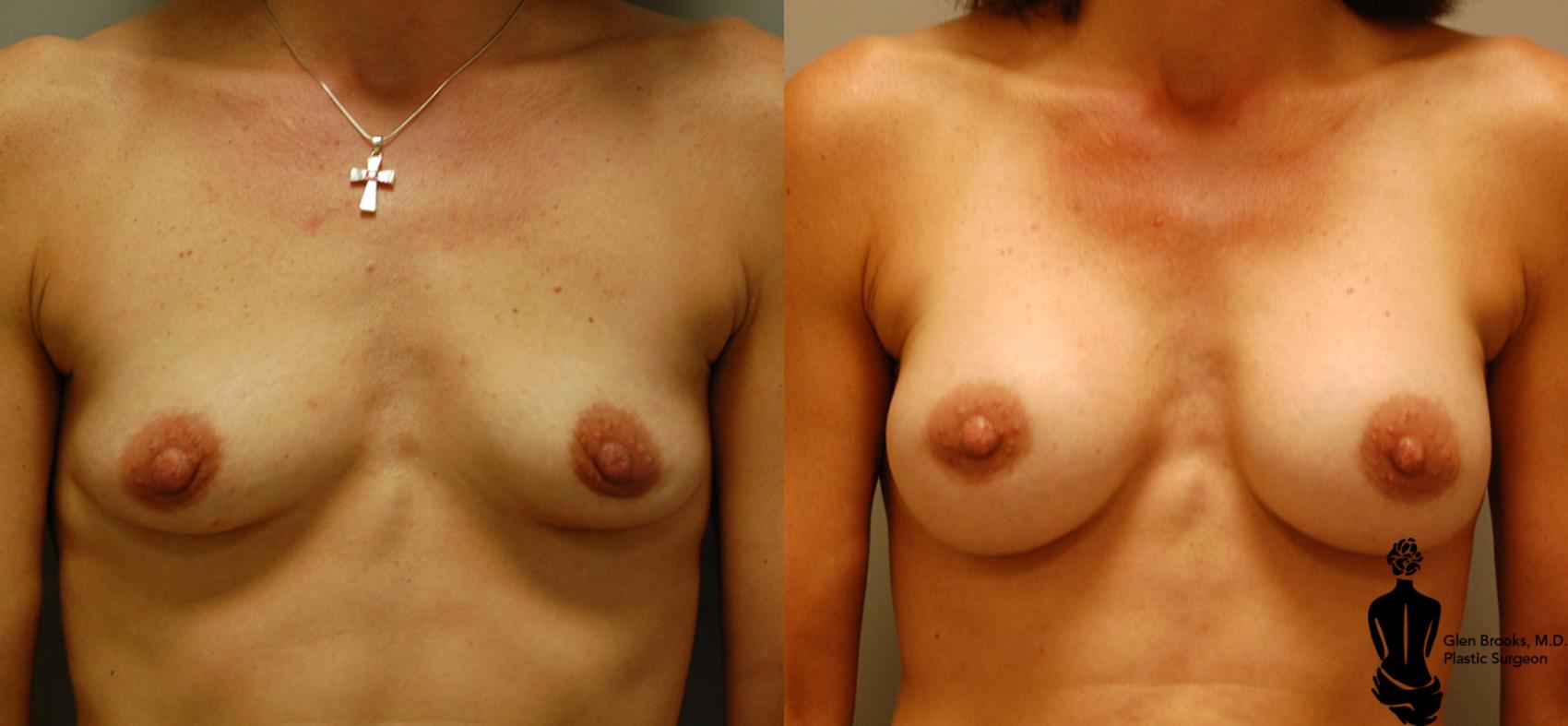 Before & After Breast Augmentation Case 7 View #1 View in Springfield, MA