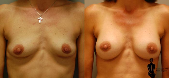 Before & After Breast Augmentation Case 7 View #1 View in Springfield, MA