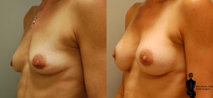 Before & After Breast Augmentation Case 7 View #2 View in Springfield, MA
