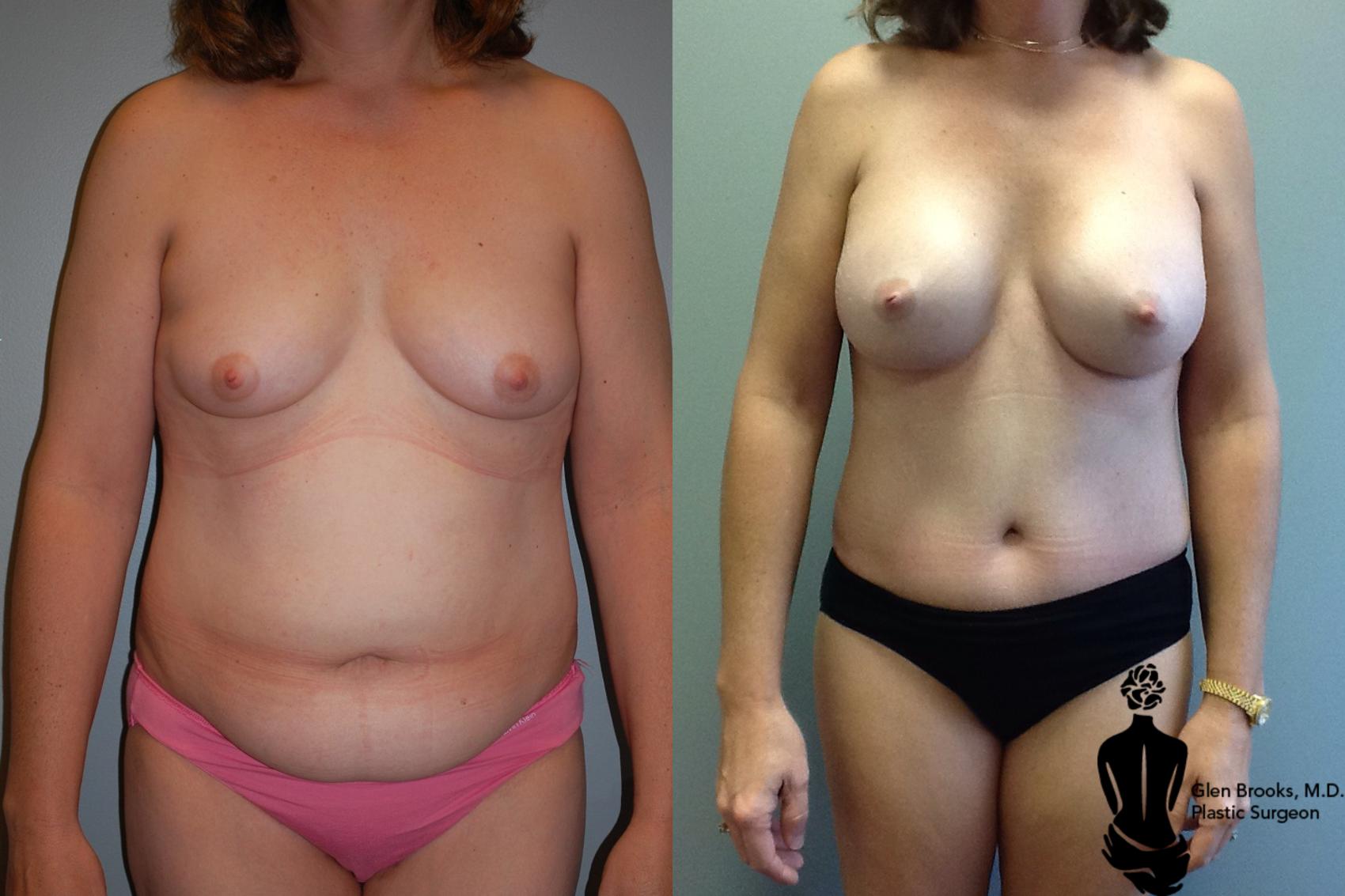 Before & After Breast Augmentation Case 71 View #1 View in Springfield, MA