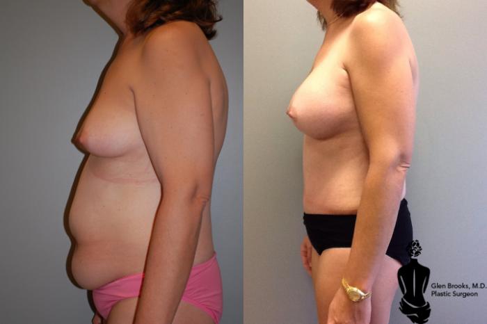 Before & After Breast Augmentation Case 71 View #2 View in Springfield, MA