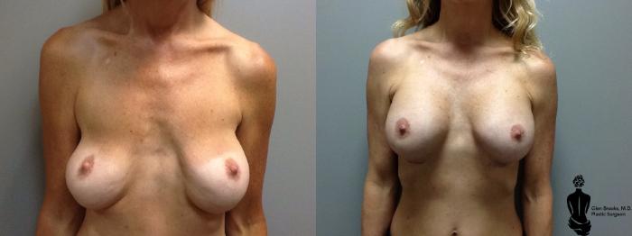 Before & After Breast Augmentation Case 78 View #1 View in Springfield, MA