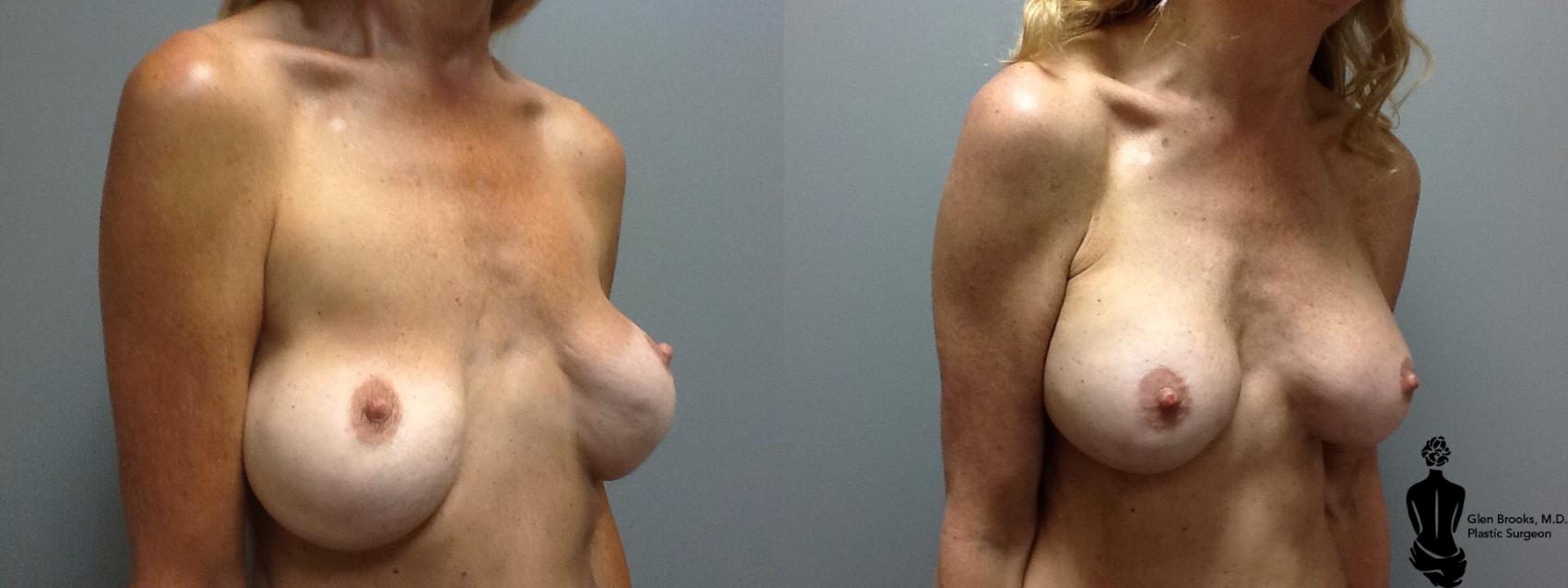 Breast Augmentation Before & After Photo | Springfield, MA | Aesthetic Plastic & Reconstructive Surgery