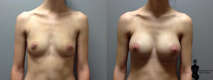 Before & After Breast Augmentation Case 79 View #1 View in Springfield, MA