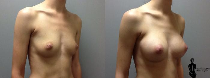 Before & After Breast Augmentation Case 79 View #2 View in Springfield, MA