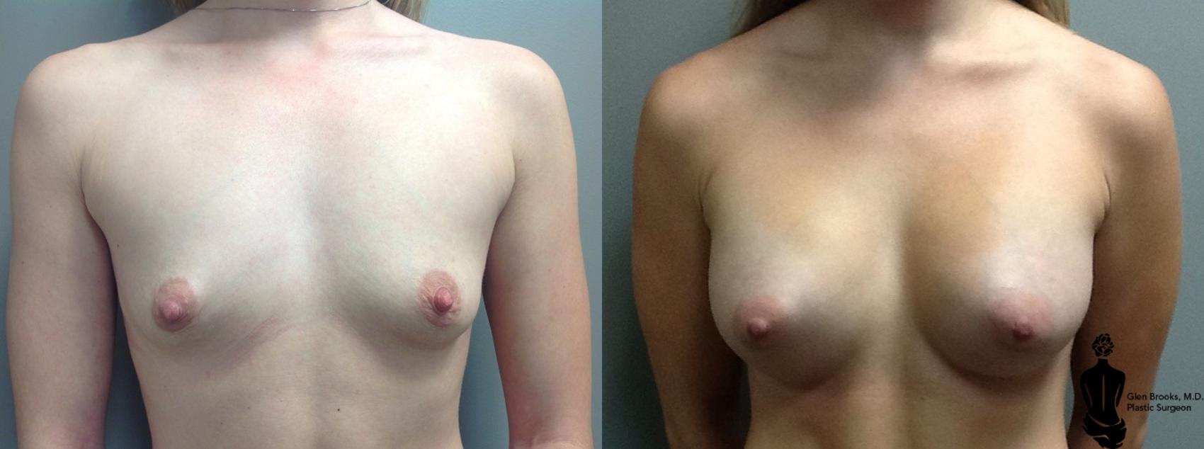 Breast Augmentation Before & After Photo | Springfield, MA | Aesthetic Plastic & Reconstructive Surgery