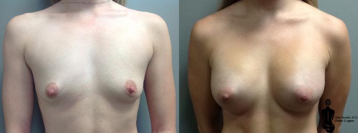 Before & After Breast Augmentation Case 95 View #3 View in Springfield, MA