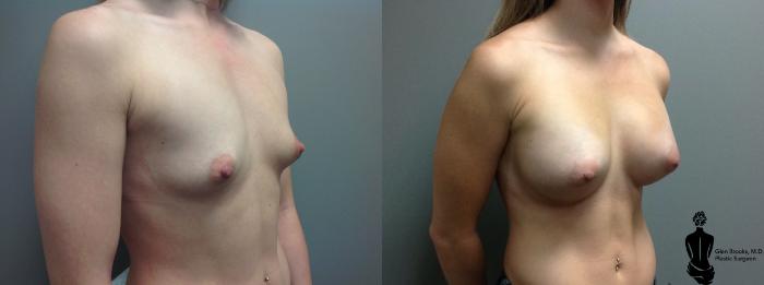 Before & After Breast Augmentation Case 95 View #4 View in Springfield, MA