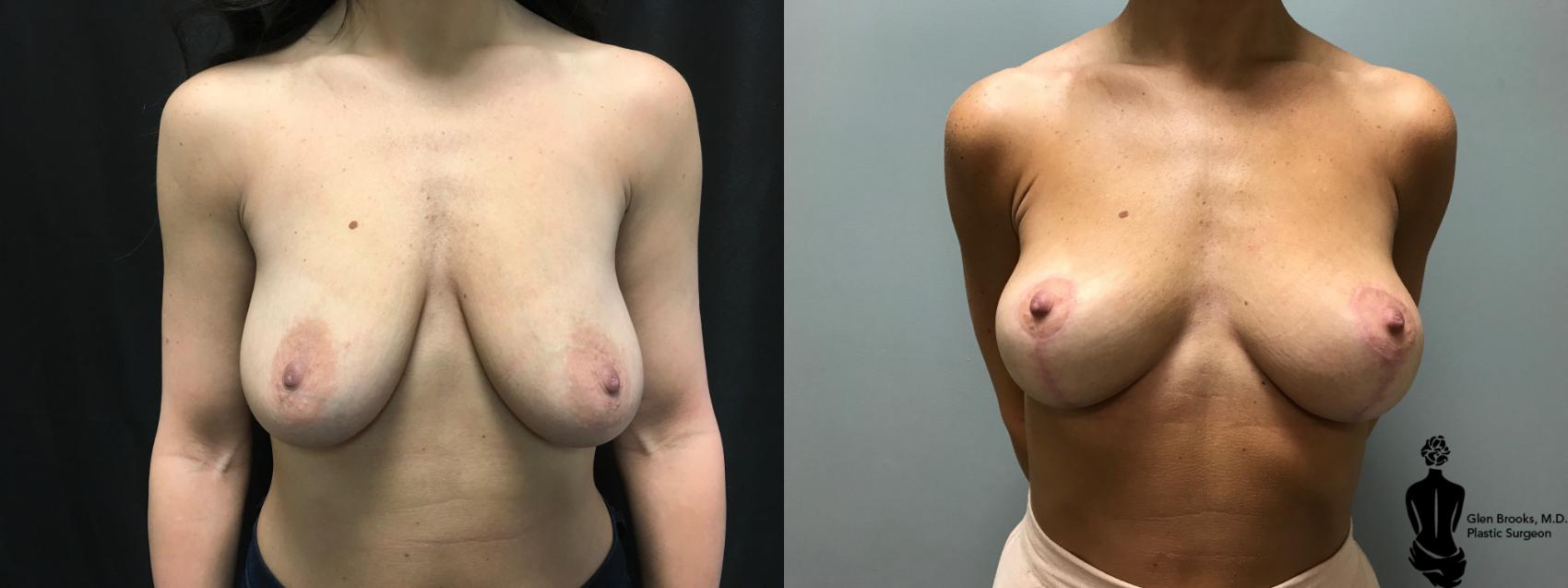 Before & After Breast Lift Case 138 View #1 View in Springfield, MA