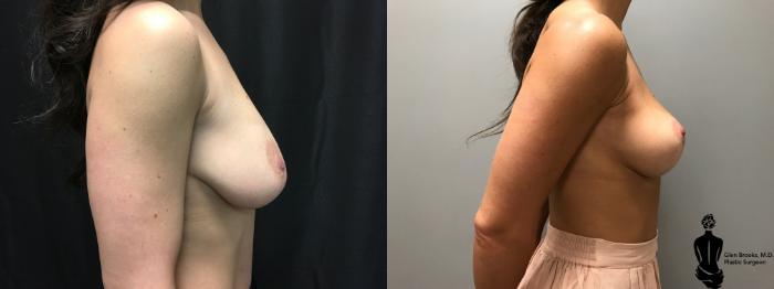 Before & After Breast Lift Case 138 View #2 View in Springfield, MA