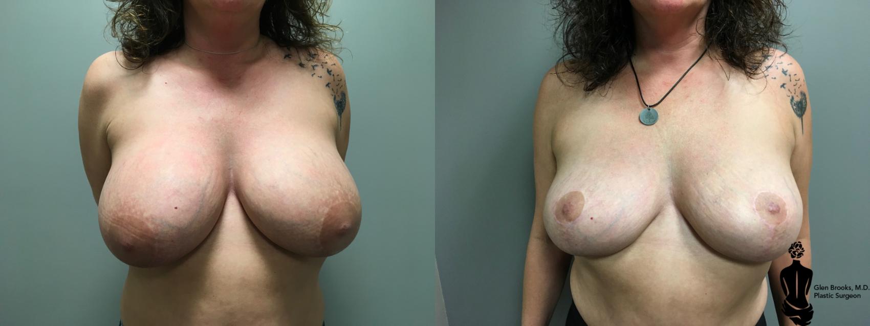 Before & After Breast Lift Case 146 View #1 View in Springfield, MA