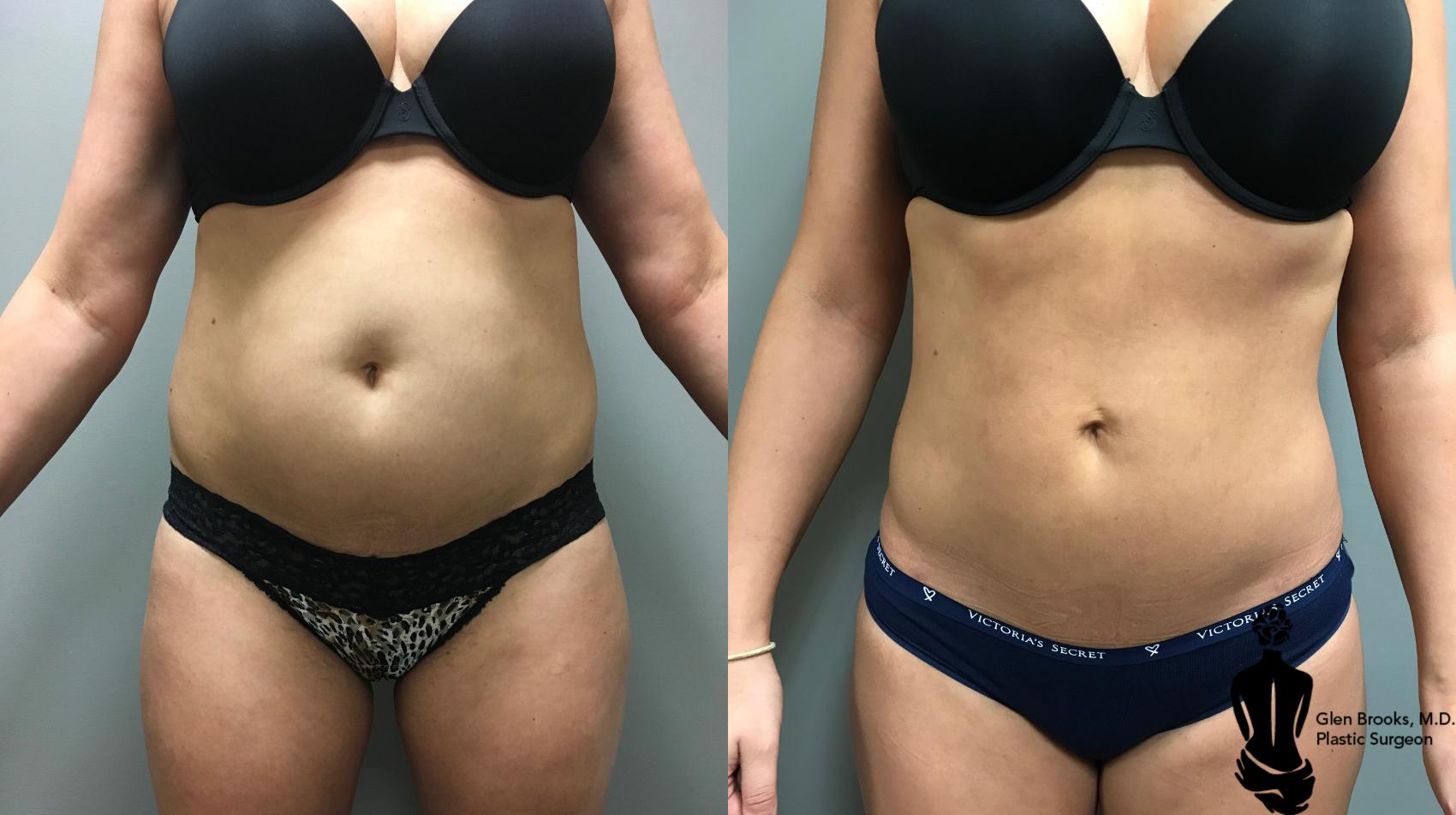 Before & After Breast Lift Case 147 View #1 View in Springfield, MA