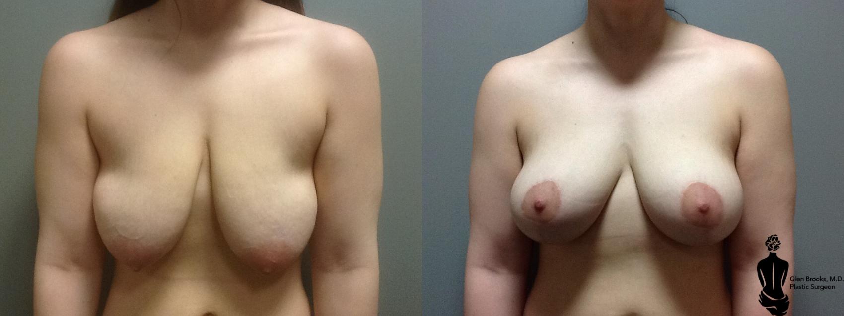 Before & After Breast Lift Case 63 View #1 View in Springfield, MA