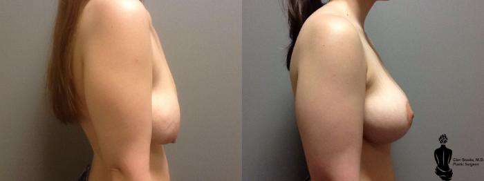 Before & After Breast Lift Case 63 View #2 View in Springfield, MA