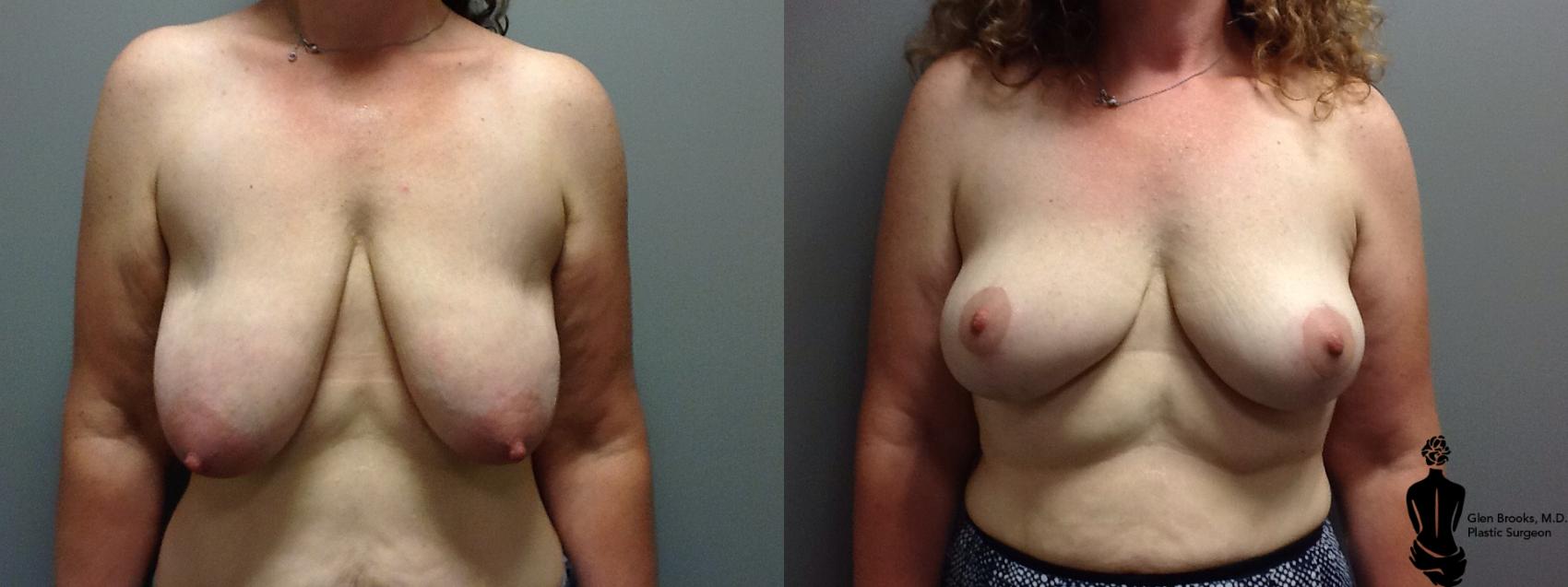 Before & After Breast Lift Case 64 View #1 View in Springfield, MA