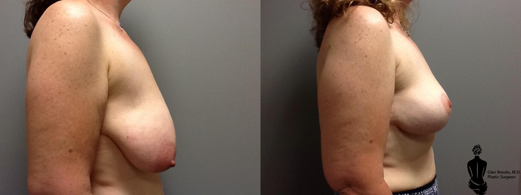 Breast Lift Before & After Photo | Springfield, MA | Aesthetic Plastic & Reconstructive Surgery