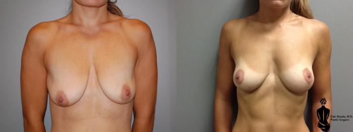 Before & After Breast Lift Case 65 View #1 View in Springfield, MA