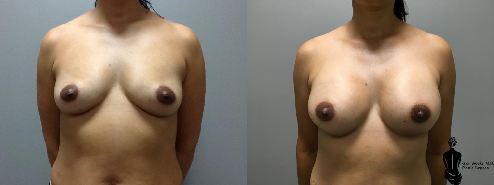 Before & After Breast Reconstruction Case 101 View #1 View in Springfield, MA