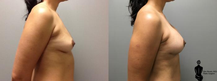 Before & After Breast Reconstruction Case 101 View #2 View in Springfield, MA