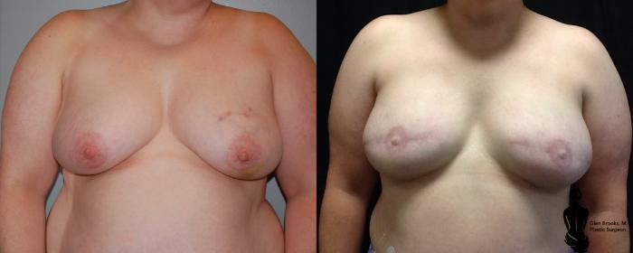 Before & After Breast Reconstruction Case 107 View #1 View in Springfield, MA