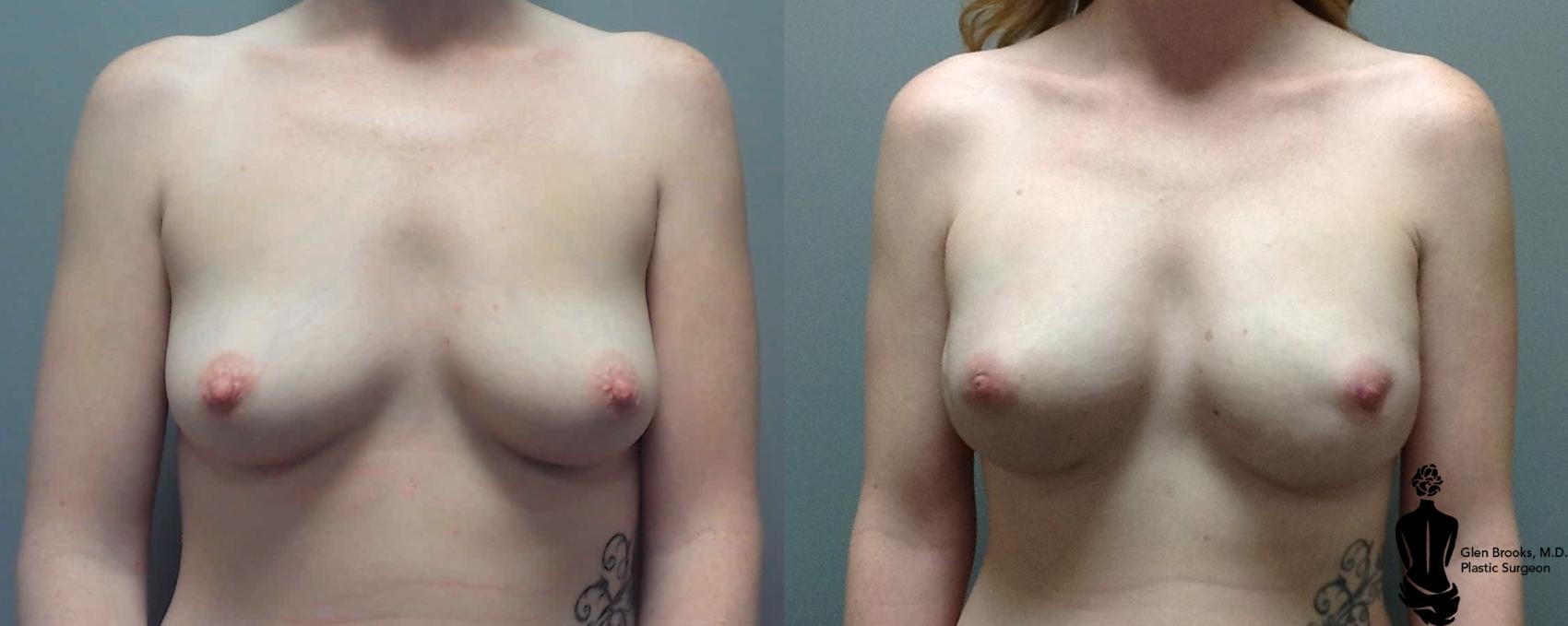 Before & After Breast Reconstruction Case 108 View #1 View in Springfield, MA