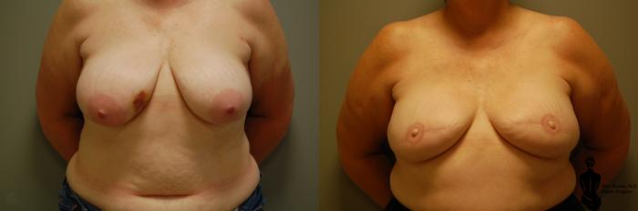 Before & After Breast Reconstruction Case 27 View #1 View in Springfield, MA
