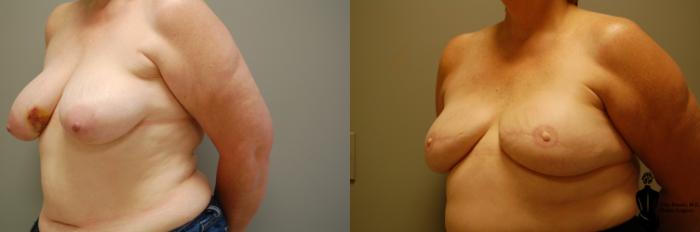 Before & After Breast Reconstruction Case 27 View #2 View in Springfield, MA
