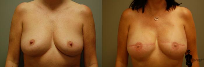 Before & After Breast Reconstruction Case 31 View #1 View in Springfield, MA