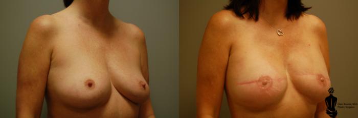 Before & After Breast Reconstruction Case 31 View #2 View in Springfield, MA