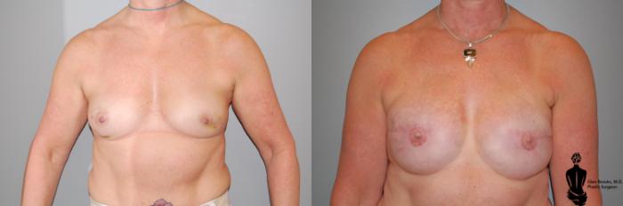 Before & After Breast Reconstruction Case 38 View #1 View in Springfield, MA