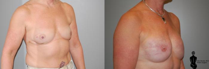Before & After Breast Reconstruction Case 38 View #2 View in Springfield, MA